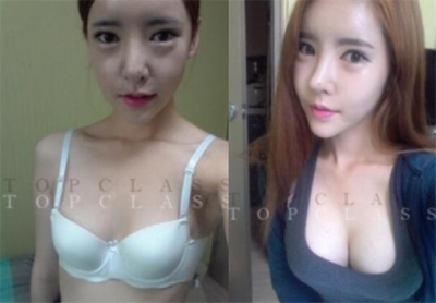 韩国topclass胸部手术前后对比照片