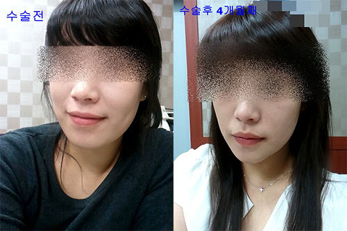 韩国伍人整形外科下颌角案例照片
