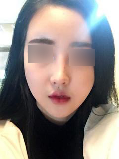 韩国nano整形外科鼻修复