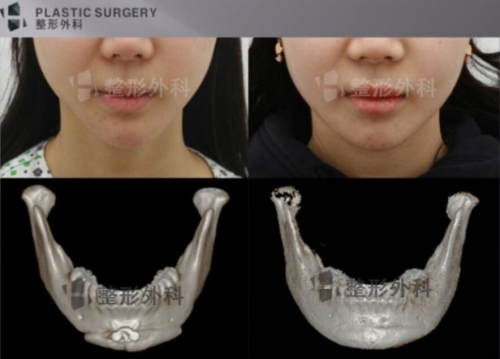 韩国白汀桓下颌角修复前后对比照片