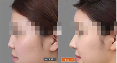 硅胶隆鼻手术对比案例