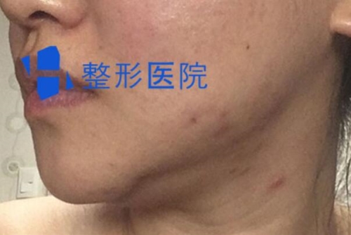 韩国H整形下颌角修复术前照片