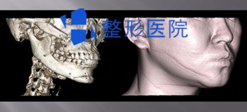 韩国H整形下颌角修复术前CT图片