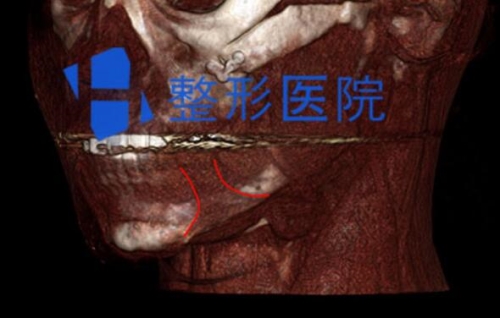 韩国H整形医院下颌角修复术前检查