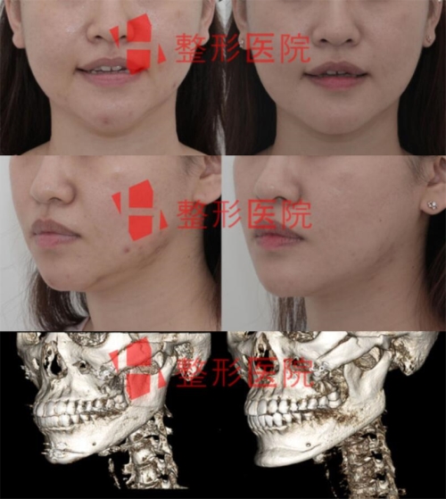 韩国白汀桓整形外科轮廓修复案例