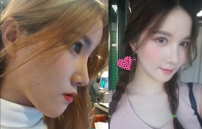 韩国ID双鄂整形+双眼皮前后对比照片