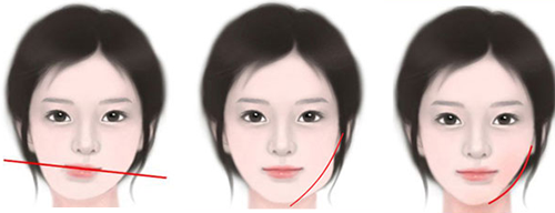 韩国偏颌手术防止越来越偏用这种方式！let美人好多如此！