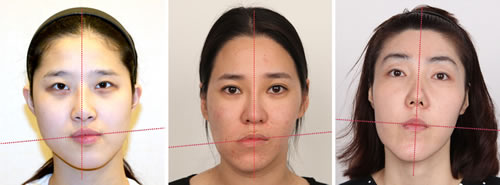 韩国偏颌手术防止越来越偏用这种方式！let美人好多如此！