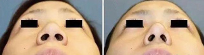 鼻孔过大造成的鼻翼宽大手术案例
