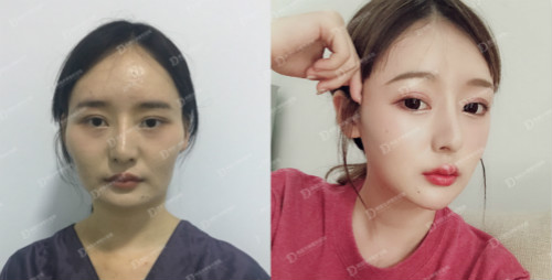 韩国女神整形外科颧骨内推对比案例