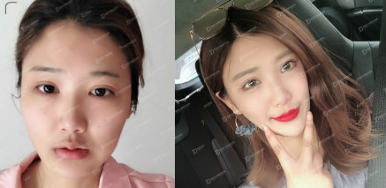 韩国女神整形外科面部轮廓案例
