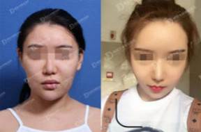 韩国女神整形外科面部轮廓综合整形