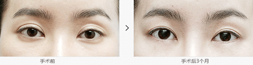 韩国医院双眼皮修复案例对比