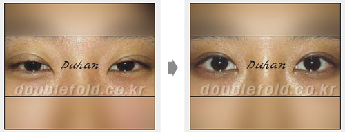韩国双眼皮疤痕修复DH斗翰和EVE两家擅长手术分析！﻿