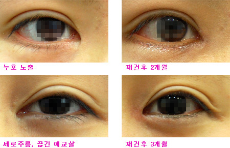 韩国EVE整形外科双眼皮修复效果展示
