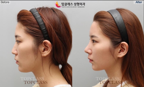 韩国自体软骨隆鼻手术前后对比照片