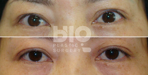 韩国BIO眼部修复前后对比照片