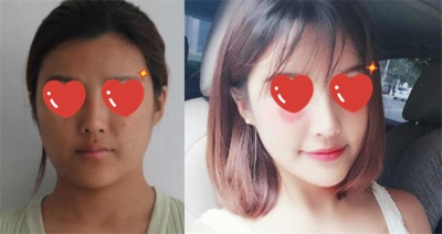 北京当代医疗美容面部埋线提升手术前后照片