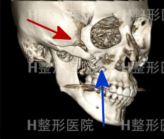 韩国H整形外科颧骨修复图示