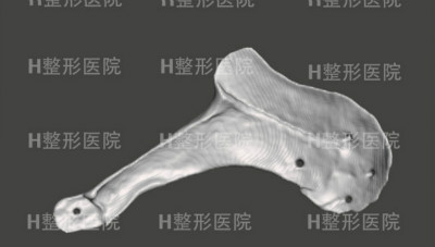 韩国H整形外科3D打印假体
