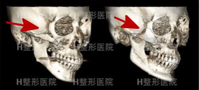 韩国H整形外科颧骨修复前后