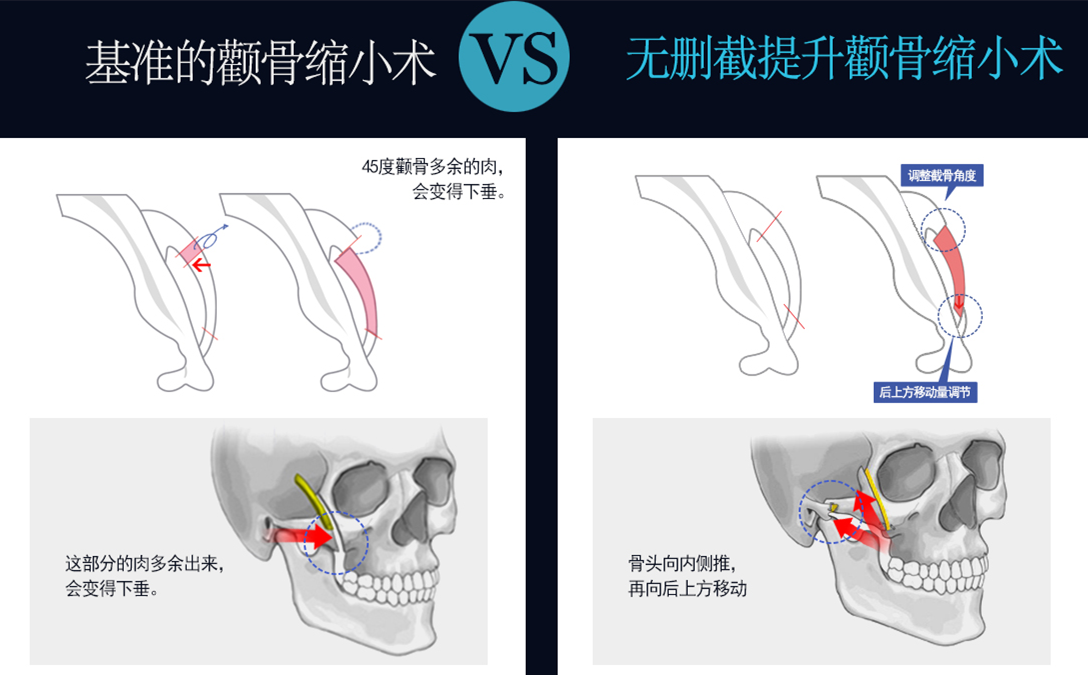 韩国菲斯莱茵整形外科颧骨整形示意图