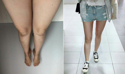 韩国美线整形外科大腿吸脂案例