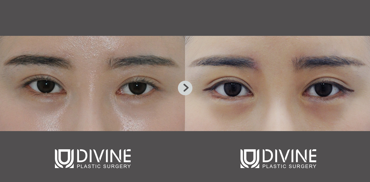 韩国divine整形外科双眼皮案例