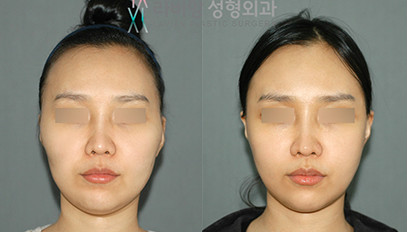 韩国拉菲安整形外科颧骨手术案例