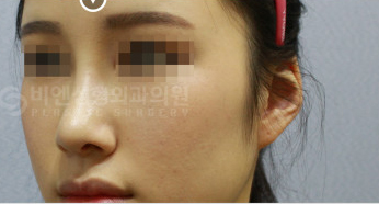 韩国BN整形外科鼻综合案例对比