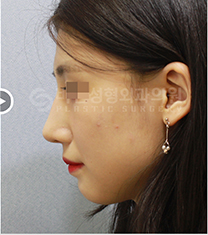 韩国BN驼峰鼻矫正前后日记对比