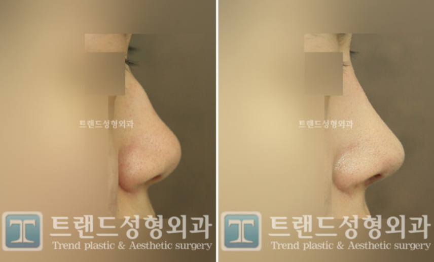 韩国trend整形外科驼峰鼻整形案例