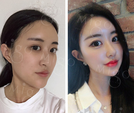 韩国migo整形网外科鼻部整形案例