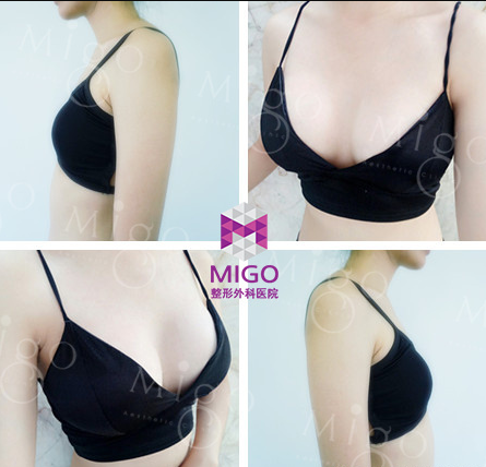 韩国migo整形外科胸部整形案例