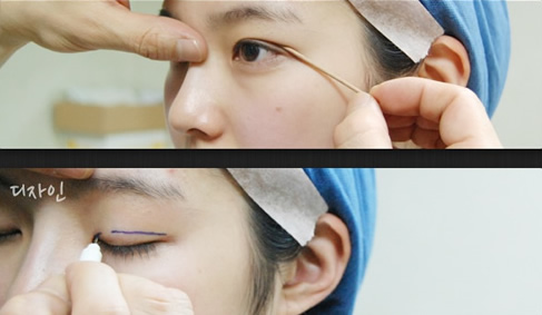 柳元敏做眼睛案例有哪些？韩国擅长眼整形医生还有谁？