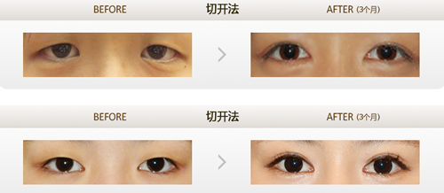 韩国李康元院长双眼皮手术案例对比
