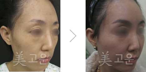 韩国美高恩整形外科祛斑案例图
