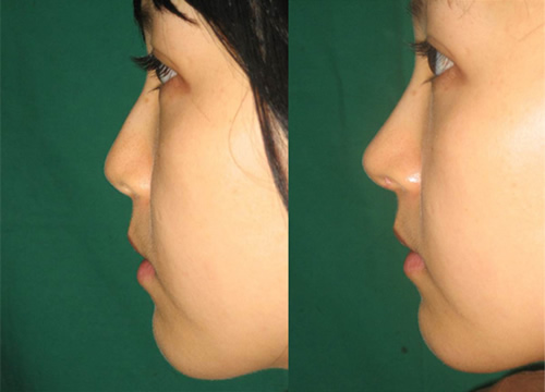 可安美整形外科隆鼻案例对比