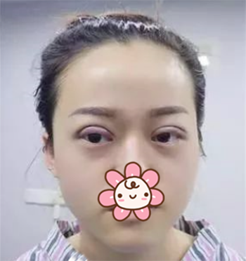 丽丝塔双眼皮手术优势