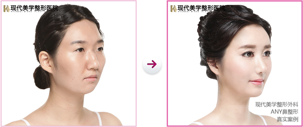 韩国现代美学整形外科隆鼻案例