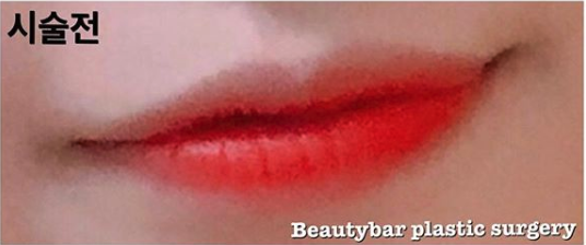 韩国beautybar注射微笑唇日记