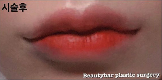 韩国beautybar唇部整形日记