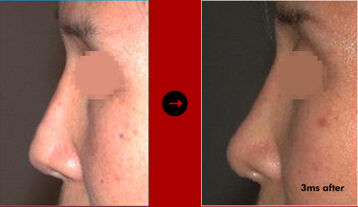 韩国SR整形外科假体隆鼻修复手术案例