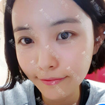 韩国丽偶整形外科全脸脂肪填充案例分享对比
