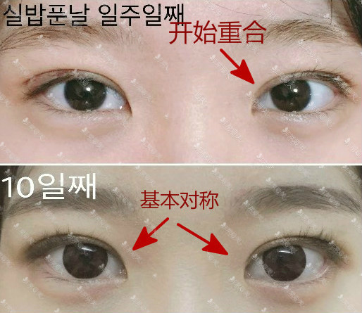 韩国蜡笔双眼皮术后7—10天效果