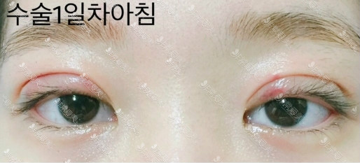 韩国蜡笔整形外科双眼皮肿胀期