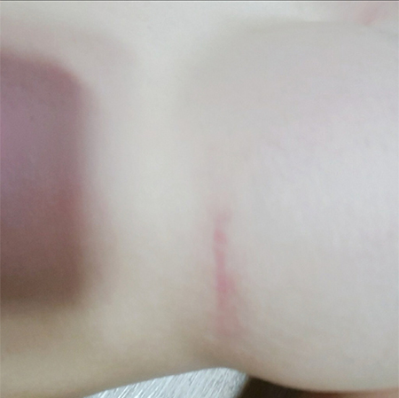 韩国Glam整形外科隆胸手术疤痕展示