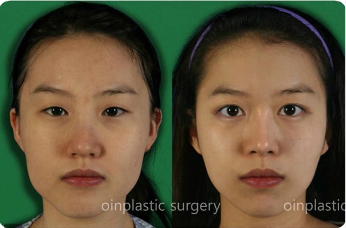 韩国伍人整形外科下颌角案例对比