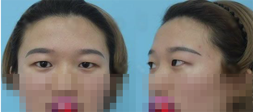 宁波韩美整形医院眼部手术前照片
