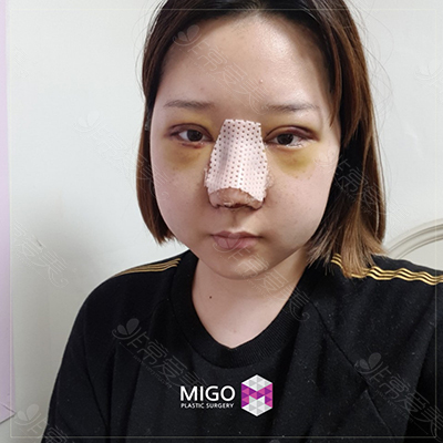 韩国MIGO眼综合术后照片